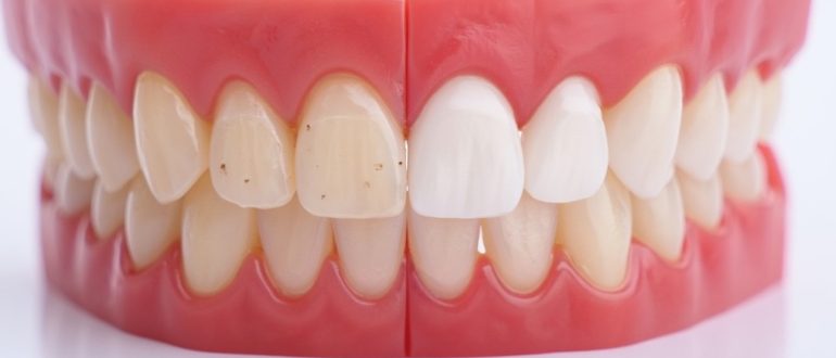 Циркониевые вениры идеальная улыбка навсегда