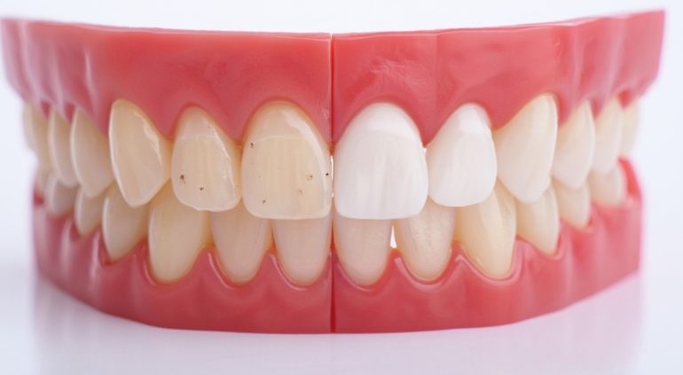 Циркониевые вениры идеальная улыбка навсегда